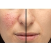 THE ORDINARY AHA 30% + BHA 2% Peeling Kwasowy 30ml